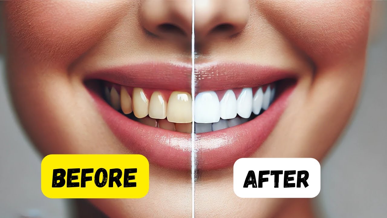 How to Get Whiter Teeth in a Few Days? Teeth Whitening at Home YouTube
