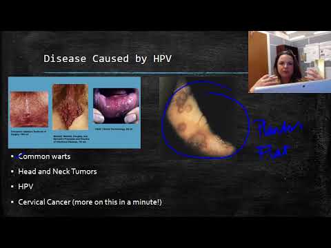 Video: Human Papillomavirus In Men: Symptoms, Treatment, Photos, How It Is Transmitted