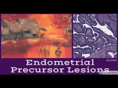 Endometrial precursor lesions: EIC or EIN?