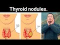 Thyroid nodules  relax blood vessels and lower high blood pressure  wudang zidong