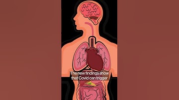 Long Covid Study Links Lingering Virus With Bowel-to-Brain Havoc