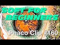 Phaco clip 160  soft cataract for beginners