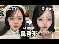 【鼻整形】ダウンタイムと経過報告!5ヶ月目🪄
