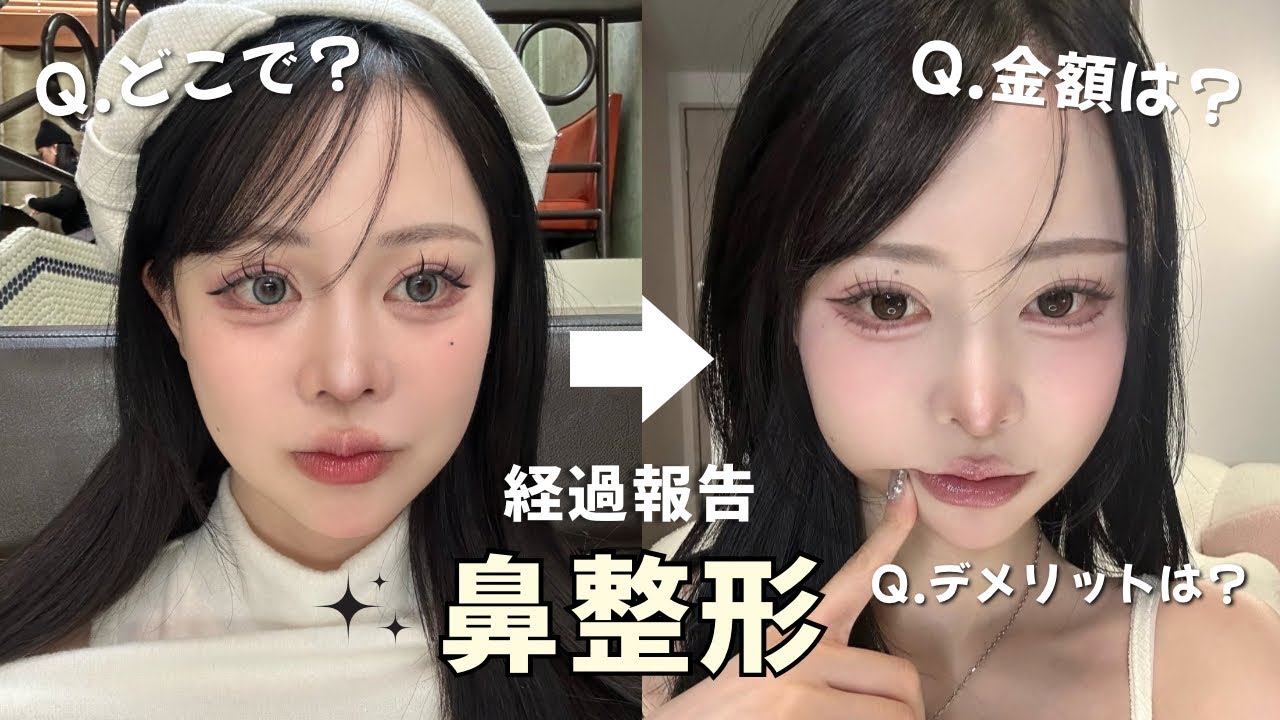 鼻整形】ダウンタイムと経過報告！5ヶ月目🪄 - YouTube