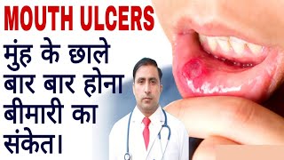 MOUTH ULCER || मुंह के छाले बार बार होना बीमारी का संकेत। || Dr Kumar education clinic