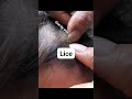 lice infestation #headliceremoval #licecomb #headlice #headlicetreatment #hairlice #haircare #hair
