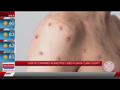 More than 30 confirmed monkeypox cases in Santa Clara County