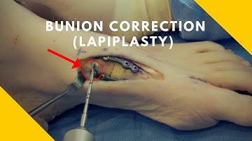 Full Bunion Correction - Lapiplasty Procedure Demonstration