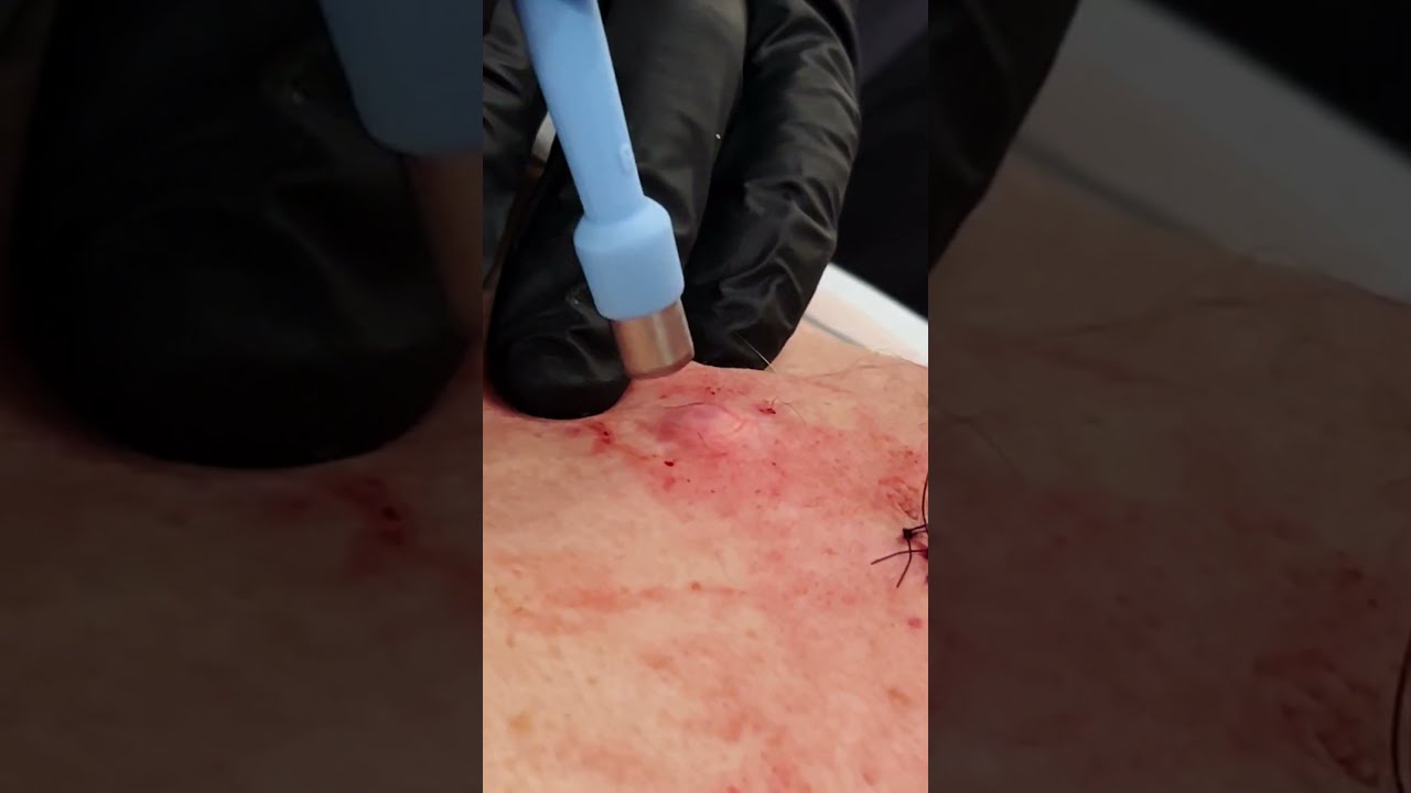 DOUBLE BACK CYST PT 2