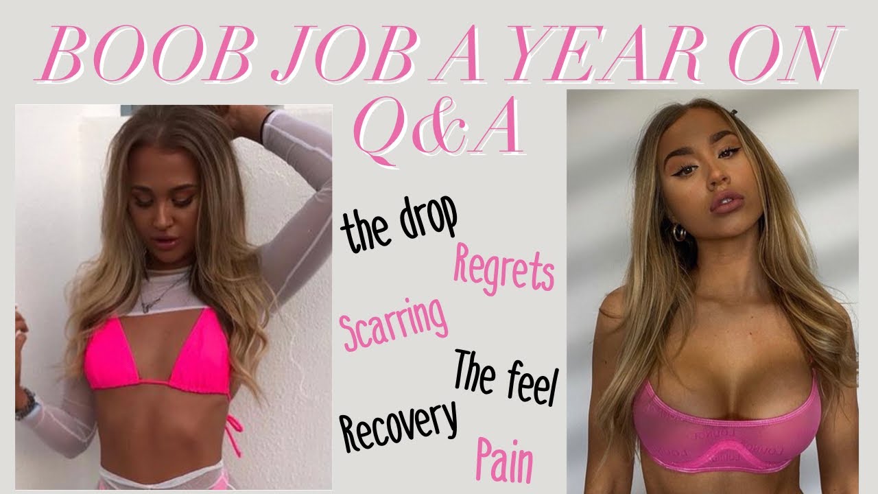 HONEST Breast augmentation/BOOB JOB Q&A (1 year later) ~The drop? Size  regrets? Scarring? Pain? 