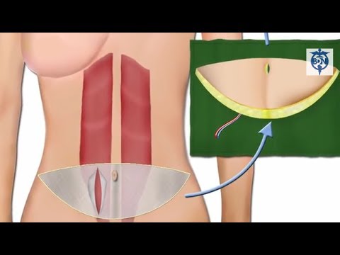 bilateral-diep-flap-reconstruction-with-plastic-surgeon-dr.-ned-snyder