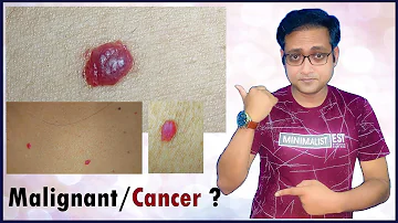 Cherry angioma - can it be malignant ? Hindi