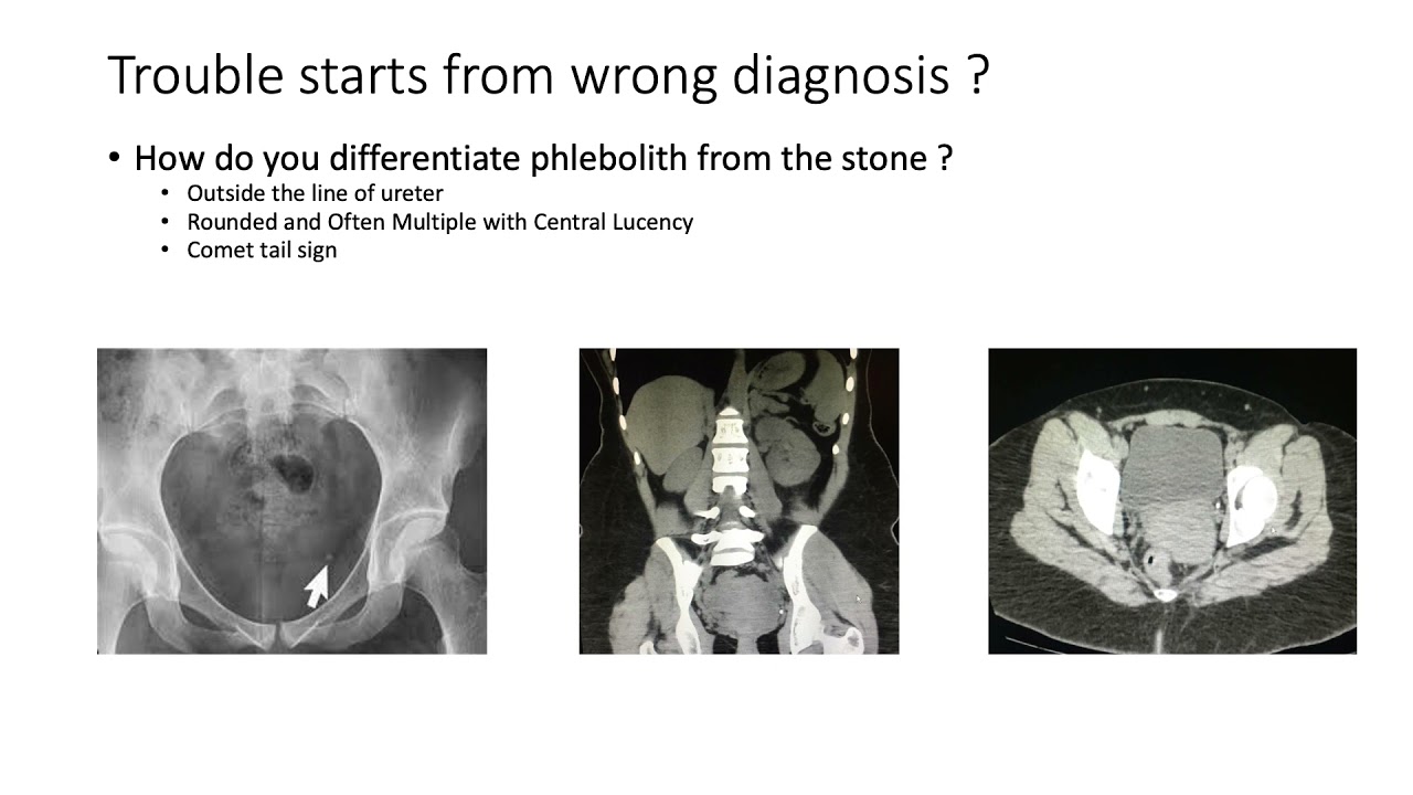 Phlebolith v/s Lower Ureteric Stone How to Diffrentiate ? YouTube