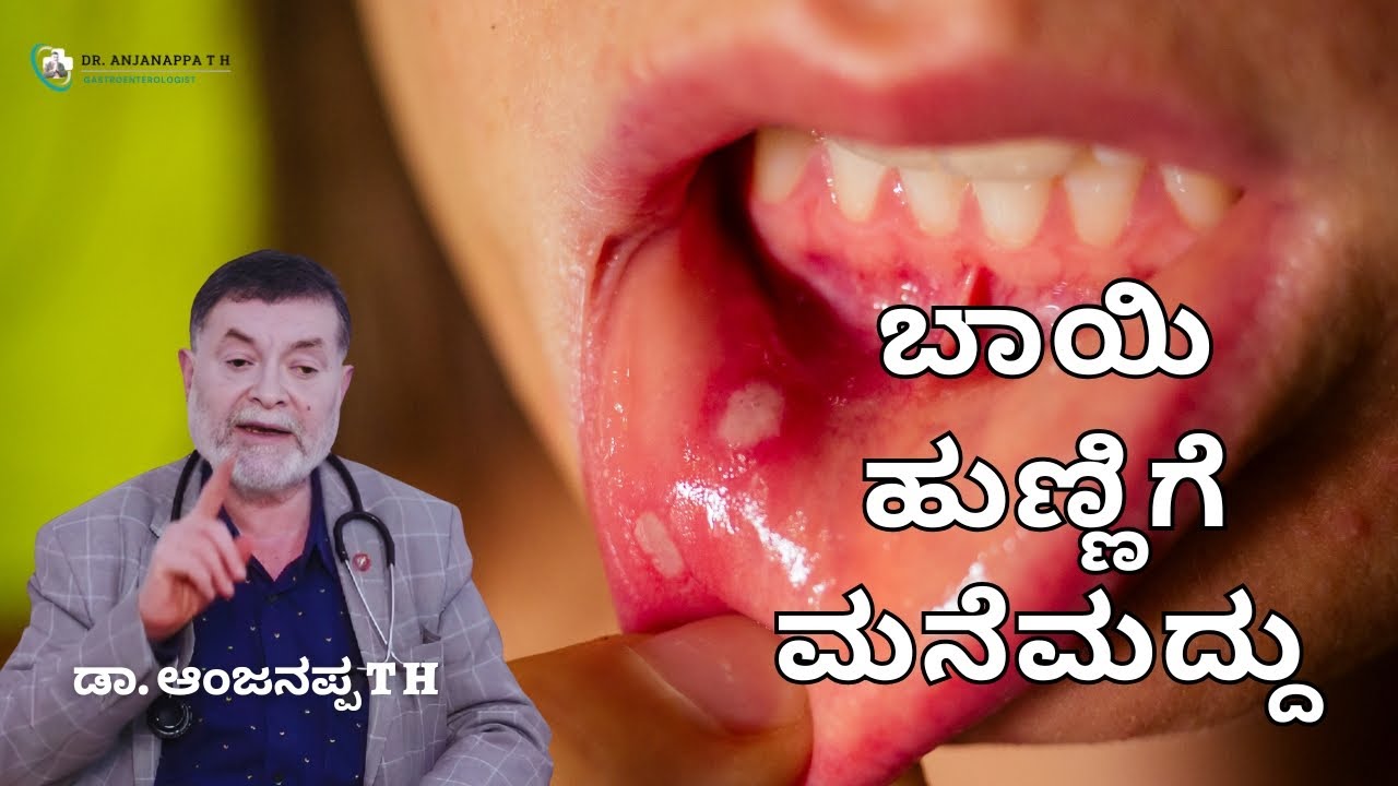 ಬಾಯಿ ಹುಣ್ಣಿಗೆ ಮನೆಮದ್ದು - Dr. Anjanappa T H
