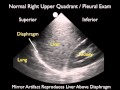 How To: Ultrasound Detection of Pleural Fluid Case Study Video