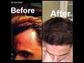 Grow Hair on Receding Hairline Naturally! (dermaroller and essential oils)