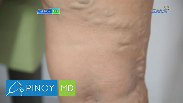 Pinoy MD: Lunas para sa varicose veins at stretch marks