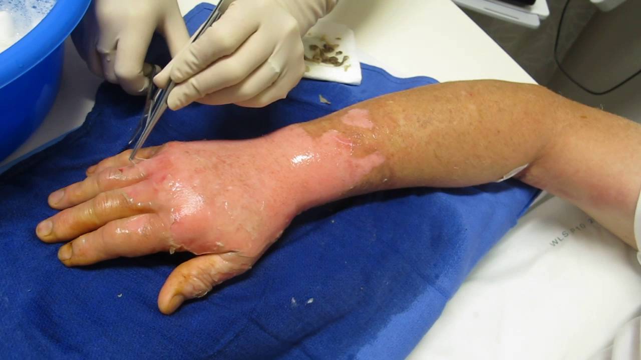 Burn Blister Debridement 