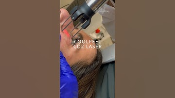 CoolPeel CO2 Laser Treatment to reduce under-eye wrinkles and rejuvenate the eyelids
