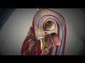 Transcatheter aortic valve implantation tavi
