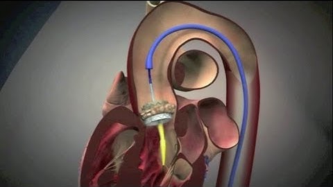 Transcatheter Aortic Valve Implantation (TAVI)