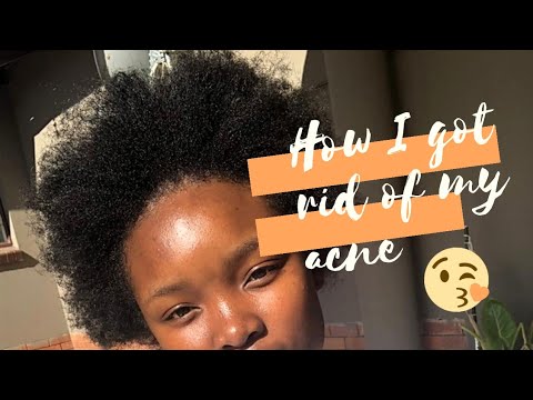 MY ACNE JOURNEY | HOW I GOT RID OF MY ACNE // South African YouTuber ...