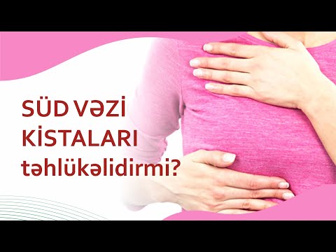 Süd vəzi kistaları təhlükəlidirmi?  Müalicəyə ehtiyac varmı?  #südvəzikistaları #onkoloq