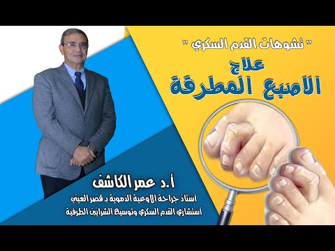 تشوهات القدم السكري #الاصبع_المطرقة