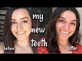 MY INVISALIGN IS FINISHED! (Before & After)