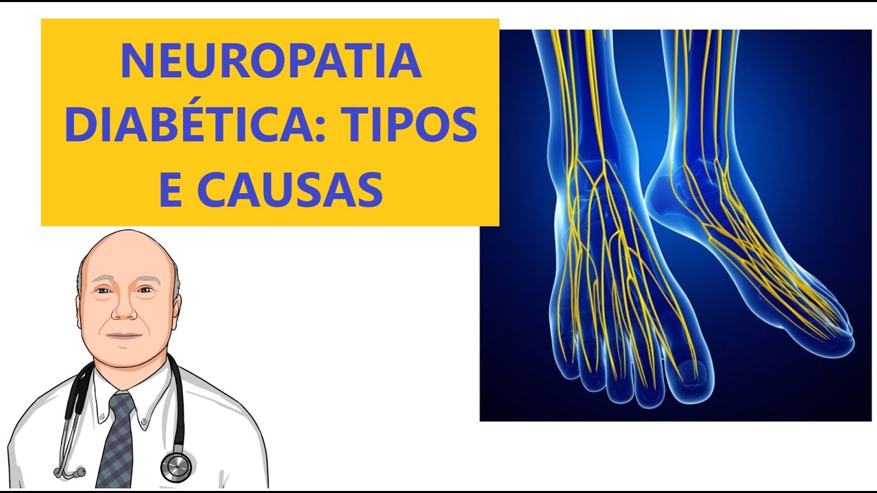 As causas e os diferentes tipos da neuropatia diabética: queimação, formigueiro, dormência e dores.
