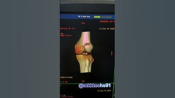 Ctscan 3D Knee( fracture ) #shorts #short #ctscan