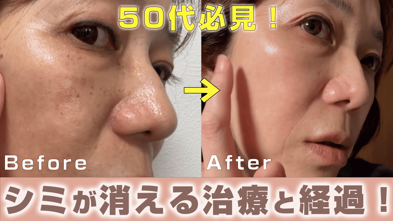 本 【美品】シミの治療 このシミをどう治す?