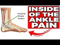 Inside of the Ankle Pain [Posterior Tibial Tendonitis Treatment] 2020