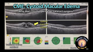 CataractCoach 1461: cystoid macular edema CME after cataract surgery Macular Oedema Retinal Swelling After Cataract Surgery In Diabetes Or Vascular Occlusions