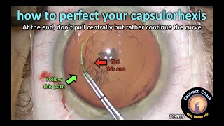 CataractCoach 1205: perfect your capsulorhexis to achieve the exact circle