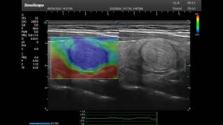 P11 ELITE WITH 12-LB LINEAR PROBE - Thyroid Scan elastography