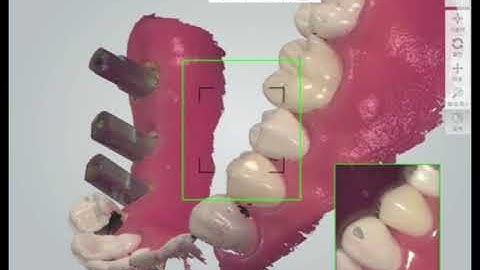Multi S & A Abutment: Intra-oral scanning