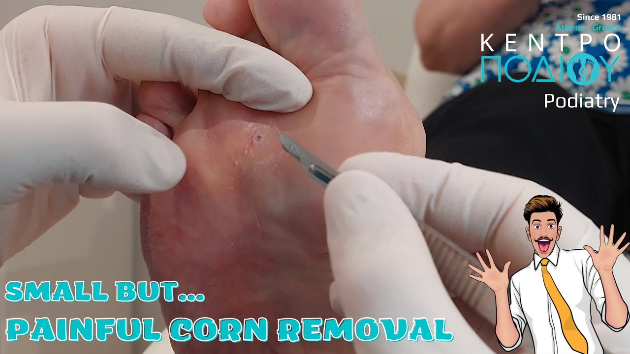 Corn removalΑφαίρεση τύλουΚέντρο Ποδιού PodiatryPodiatristPodologos