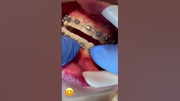 Tác dụng của dây nịt trong niềng Răng #nieng #drhuonh