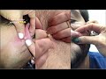 Popping huge blackheads and pimple popping  best pimple poppings 26