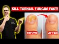 BEST Yellow Toenail Fungus Remedy & Cures! [TOP 20 Fungus Treatments]