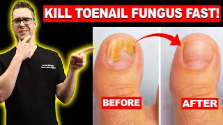 How to CURE Yellow Toenail Fungus & Toe Fungus [Remedies & Treatment] screenshot 3