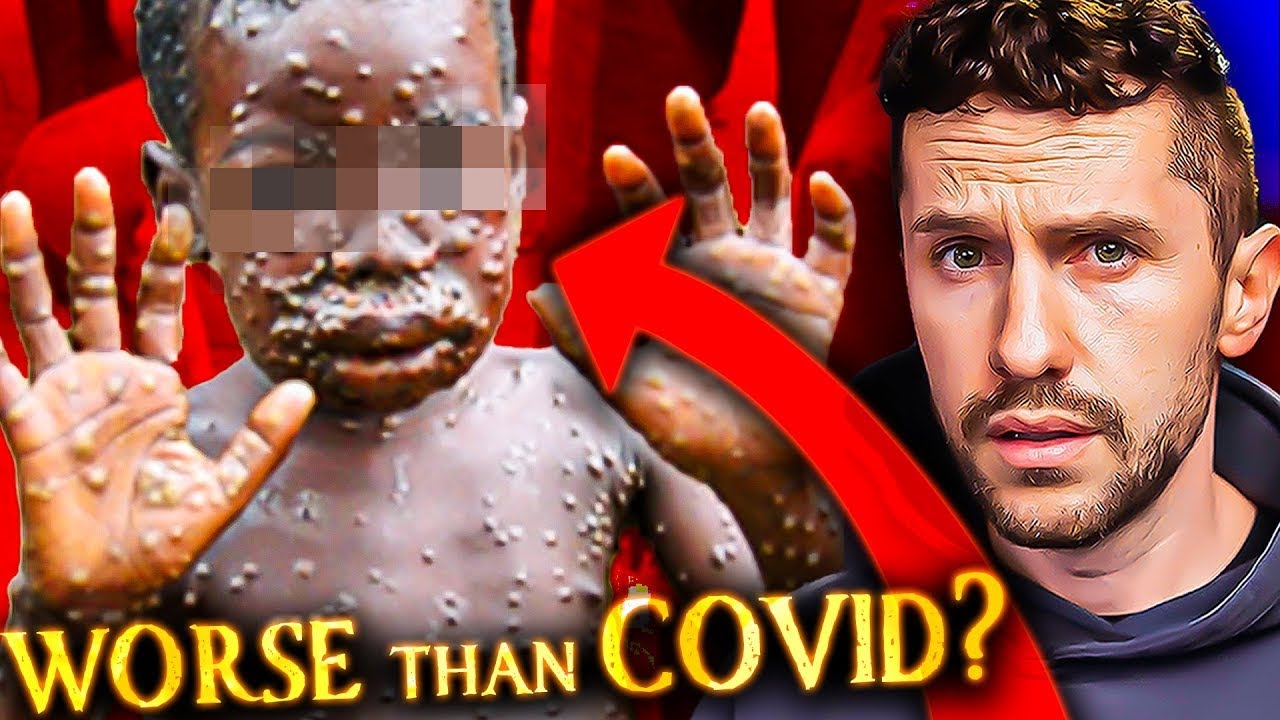 MONKEYPOX: Is the world about to shut down again?