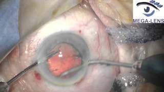 Implantation of Alcon AcrySof IQ IOL Using UltraSert Pre-loaded Delivery System in cataract surgery