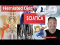 3 things to know about sciatica or back pain due to a herniated disc  neurosurgeon explains