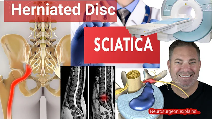 3 Things to Know About SCIATICA or BACK PAIN due to a HERNIATED DISC | Neurosurgeon explains