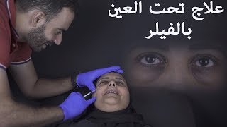 علاج تحت العين بالفيلر