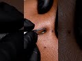 #PimplePixy #AcneClean #SatisfyingExtraction #PimplePopping #SkincareASMR 7
