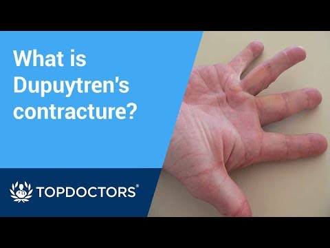 What is Dupuytren’s contracture?