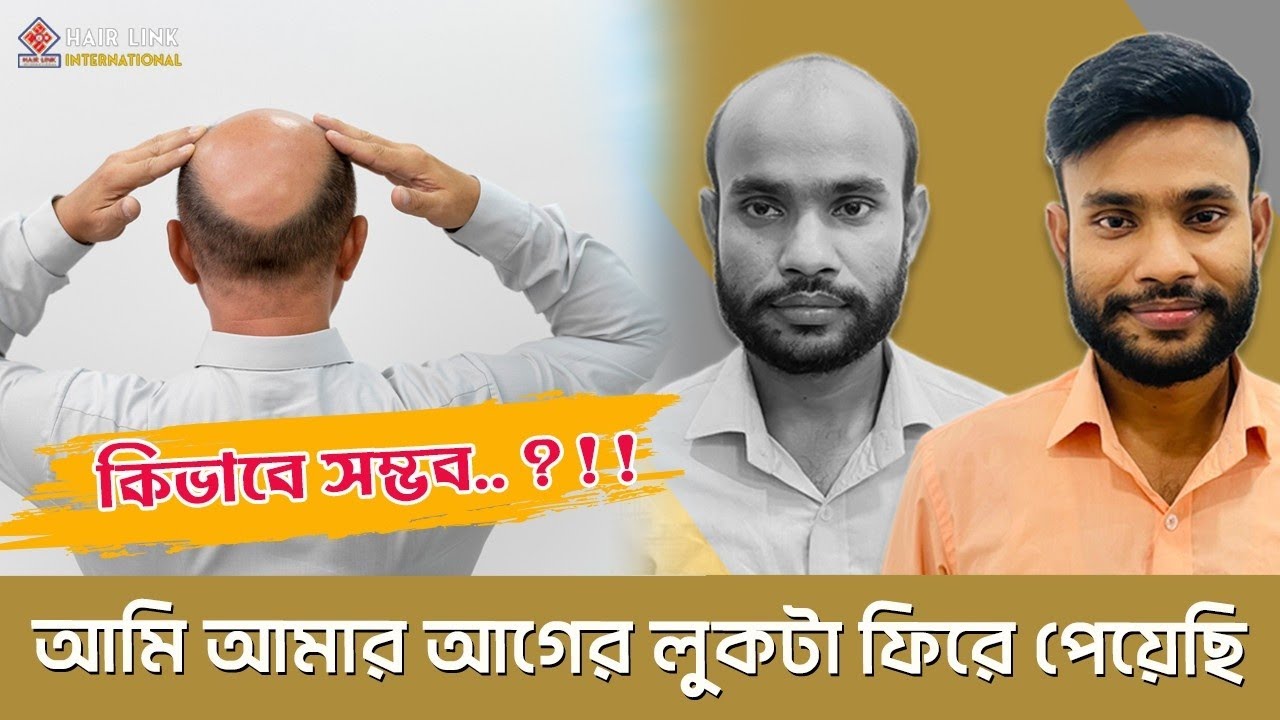 Hair System for Men Hair Patch Aftabnagar Dhaka HAIR LINK